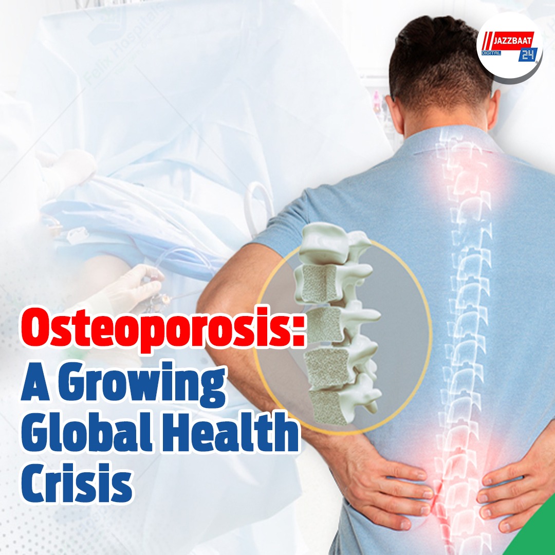 Osteoporosis emerging as a major health challenge globally