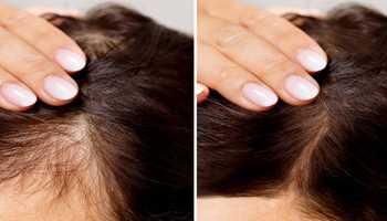 Regrow Hair Naturally: How Mustard Oil Can Help Reverse Bald Spots