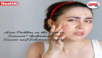 Acne problem on the face in summer? Understand its causes and solutions easily