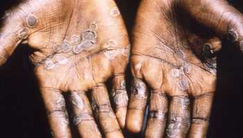 Monkeypox outbreak: Indian government asks to begin surveillance at international entry points