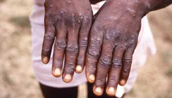 The World Health Organization has confirmed 92 cases of monkeypox in 12 countries