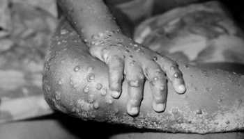 Monkeypox outbreak: 80 cases confirmed in 11 countries