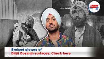 Bruised picture of Diljit Dosanjh surfaces; Check here