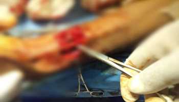 First-Ever Tendon Repair Procedure Successfully Performed at Sub District Hospital DH Pora